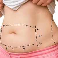 Tummy Tuck surgery in Riyadh