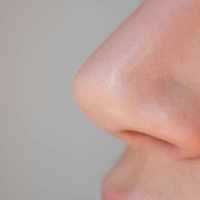 Rhinoplasty in Riyadh