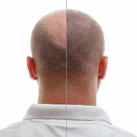 Hair Transplant in Riyadh