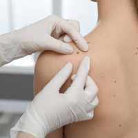 Skin Tag Removal in Riyadh