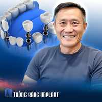 Trồng Răng Implant